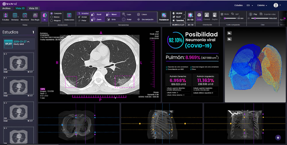 Desde Colombia: Modelo de IA con Ms, para detección complementaria del Covid-19